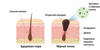 Отчего появляются черные точки на лице?