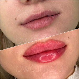 Техники увеличения губ. Что вообще можно сделать с губами?