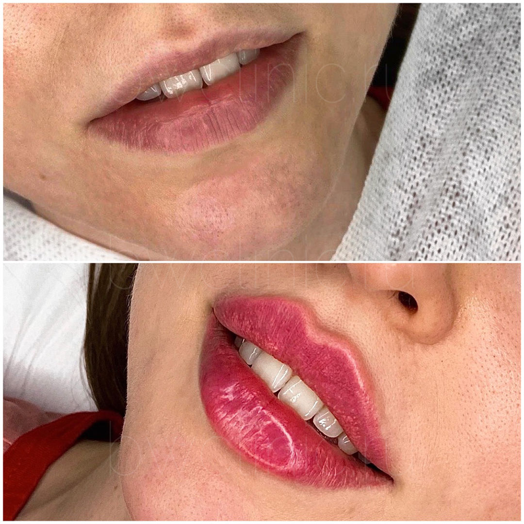 Идеальные губы изменение формы и увеличение объема