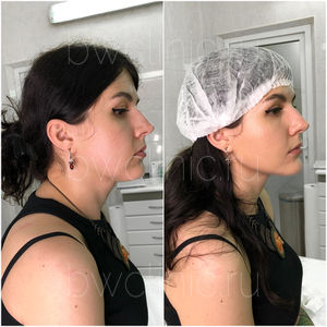 До и после инъекционной пластики лица