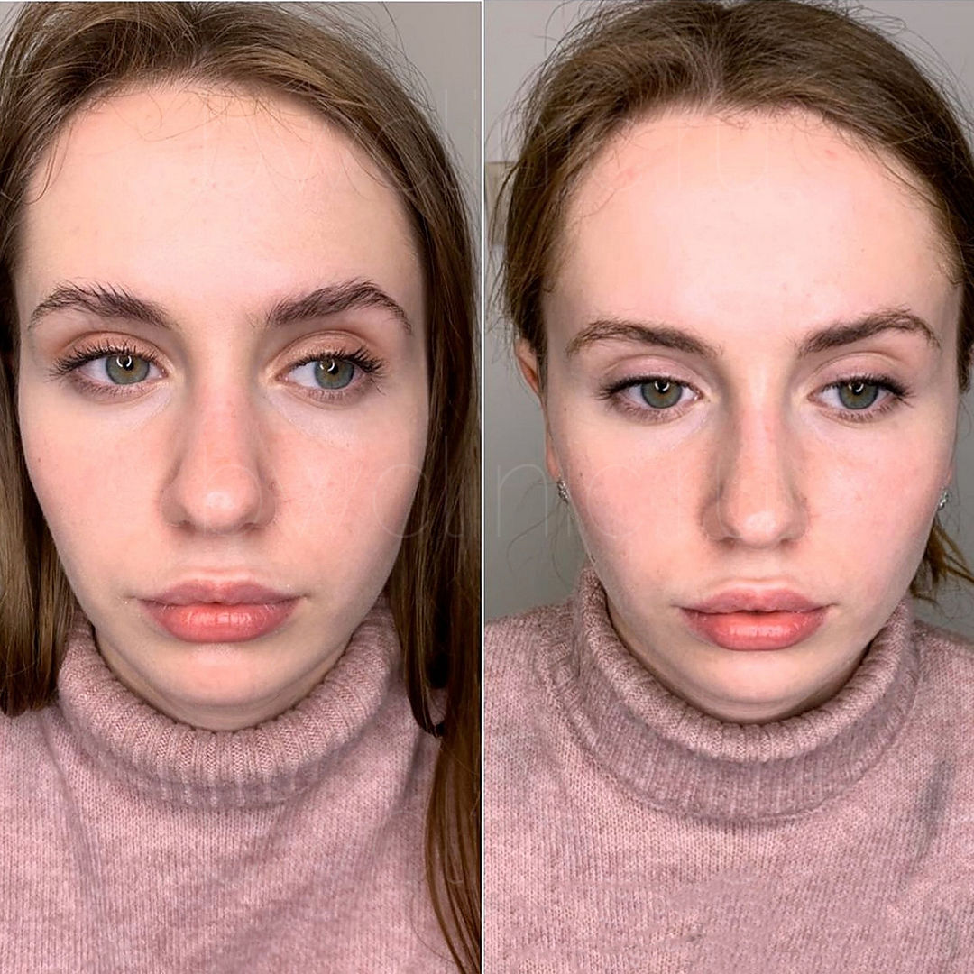 Сужение кончика носа без операции до и после фото