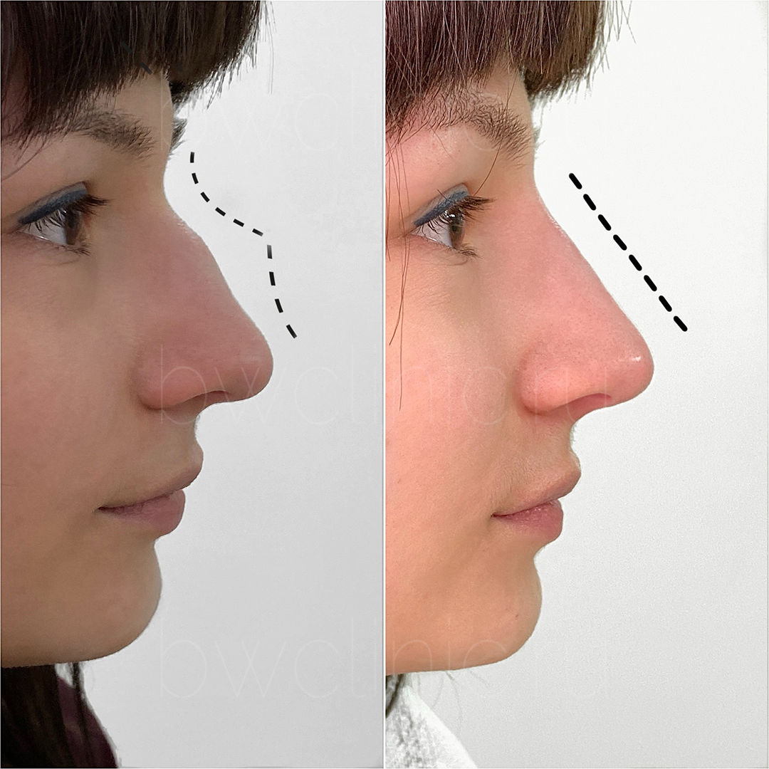 Кривой нос после перелома