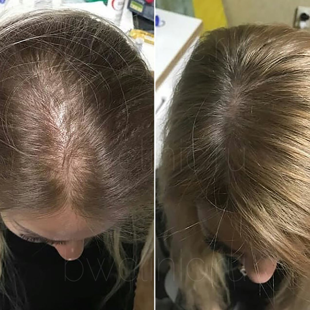 Мезотерапия кожи головы: цена от 4990 рублей в Москве | Стоимость уколов в  голову для роста волос в клинике BeautyWay Clinic