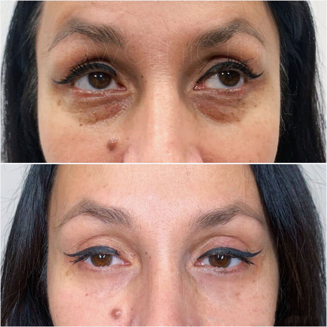 Крем-корректор против морщин для упругости кожи вокруг глаз с ретинолом и гиалуроновой кислотой
