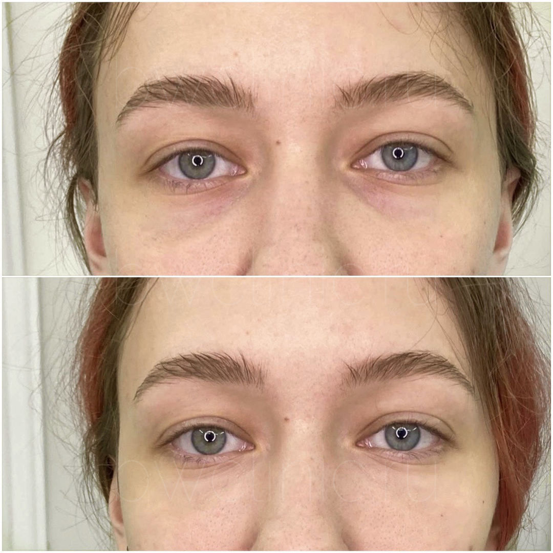 Биоревитализация кожи вокруг глаз: цены в Москве | Уколы гиалуроновой  кислоты вокруг глаз в клинике BeautyWay Clinic