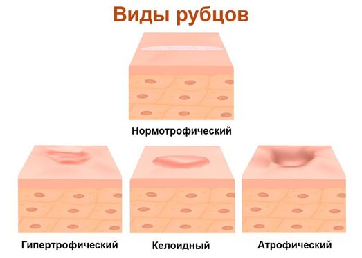 Келоидные и гипертрофические рубцы - Причины и методы Лечения 