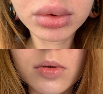 Удаление филлера из губ: цены в Москве | Убрать филлер из губ в клинике  BeautyWay Clinic