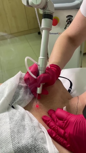 Удаление гемангиомы лазером