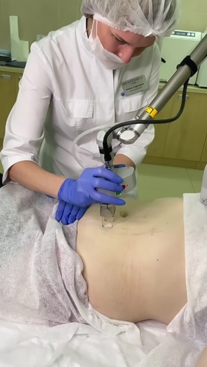 Удаление растяжек лазером СО2