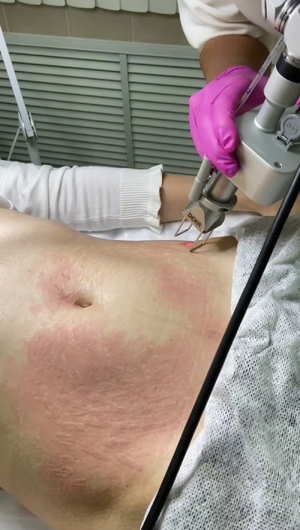 Лазерная шлифовка кожи живота