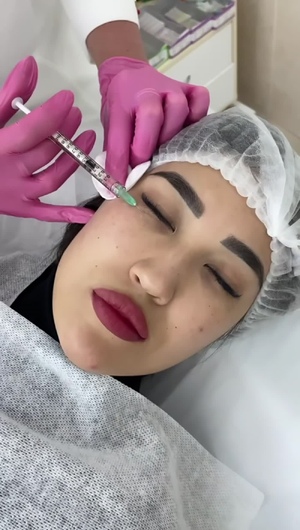 Биоревитализация кожи вокруг глаз