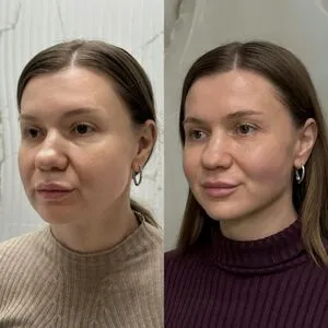 SMAS-лифтинг лица — фото до и после