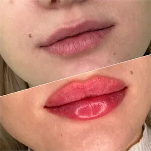 Увеличение губ гиалуроновой кислотой