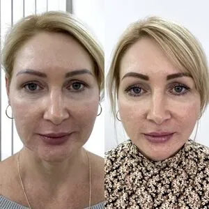 Безоперационная подтяжка лица