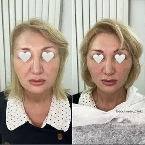Результат смас лифтинга лица
