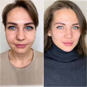 Инъекционная косметология — фото до и после
