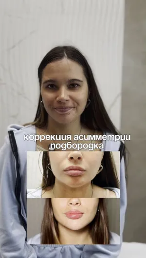 Контурная пластика нижней трети лица отзывы, результат&nbsp;до&nbsp;и&nbsp;после.