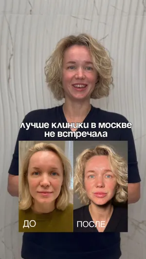 Контурная пластика губ отзывы, результат&nbsp;до&nbsp;и&nbsp;после.