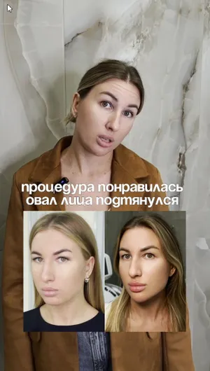 Микроигольчатый rf-лифтинг Sylfirm X отзывы, результат&nbsp;до&nbsp;и&nbsp;после.