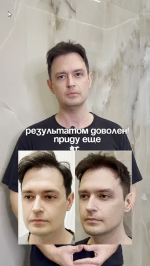 Биоревитализация и RF-лифтинг Sylfirm X отзывы, результат&nbsp;до&nbsp;и&nbsp;после.