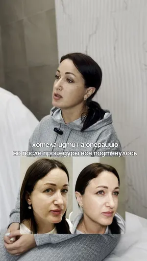 Биоревитализация и RF-лифтинг Sylfirm X отзывы, результат&nbsp;до&nbsp;и&nbsp;после.