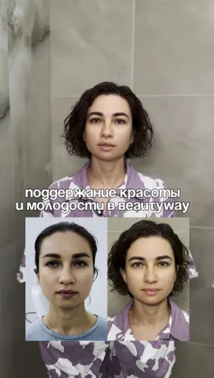 РФ-лифтинг Sylfirm X, эпиляция Moveo отзывы, результат&nbsp;до&nbsp;и&nbsp;после.