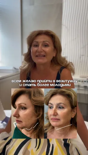 Лифтинг Нефертити отзывы, результат&nbsp;до&nbsp;и&nbsp;после.