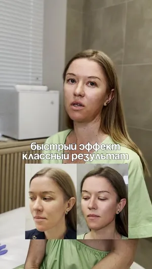 Векторный лифтинг Radiesse отзывы, результат&nbsp;до&nbsp;и&nbsp;после.
