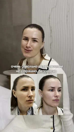 Липолитическая мезотерапия отзывы, результат&nbsp;до&nbsp;и&nbsp;после.