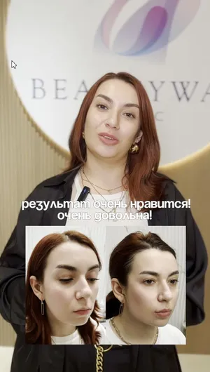 Контурная пластика Radiesse отзывы, результат&nbsp;до&nbsp;и&nbsp;после.