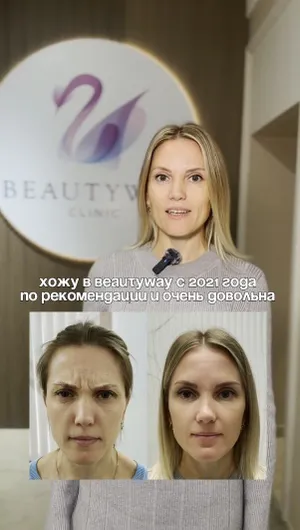 Ботулинотерапия отзывы, результат&nbsp;до&nbsp;и&nbsp;после.
