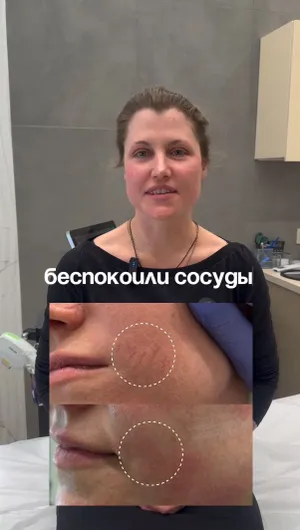 Фотоомоложение лица отзывы, результат&nbsp;до&nbsp;и&nbsp;после.