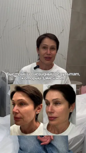 Векторный лифтинг Radiesse отзывы, результат&nbsp;до&nbsp;и&nbsp;после.