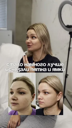 Лечение постакне отзывы, результат&nbsp;до&nbsp;и&nbsp;после.