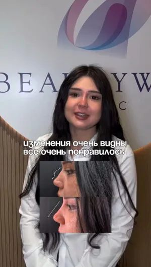 Безоперационная коррекция носа отзывы, результат&nbsp;до&nbsp;и&nbsp;после.