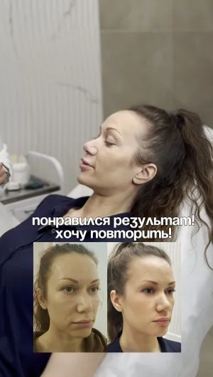 Биоревитализация отзывы, результат&nbsp;до&nbsp;и&nbsp;после.