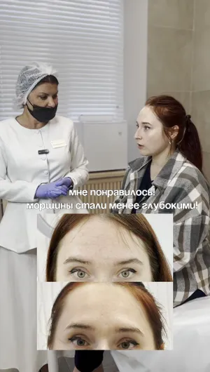 Ботулинотерапия отзывы, результат&nbsp;до&nbsp;и&nbsp;после.