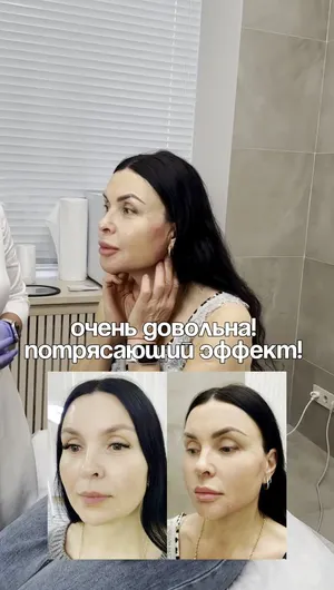 Контурная пластика Radiesse отзывы, результат&nbsp;до&nbsp;и&nbsp;после.