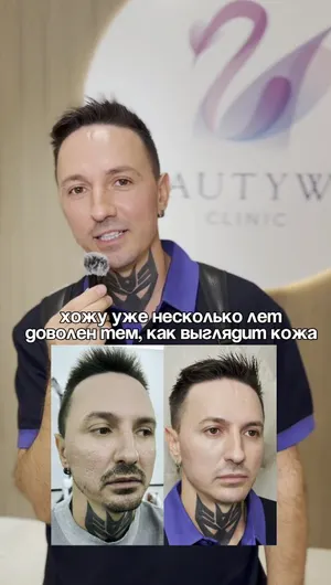 Ботулинотерапия отзывы, результат&nbsp;до&nbsp;и&nbsp;после.