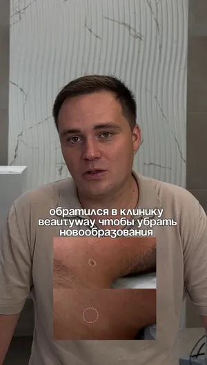 Удаление новообразования отзывы, результат&nbsp;до&nbsp;и&nbsp;после.