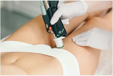 Лазерная эпиляция в зоне бикини