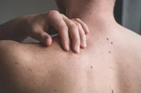 Что бывает после удаления родинки