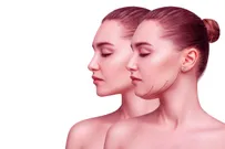 SMAS-лифтинг подбородка