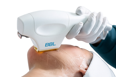 Лечение пигментации BBL Лечение пигментации BBL