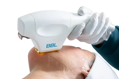 Лечение пигментации BBL