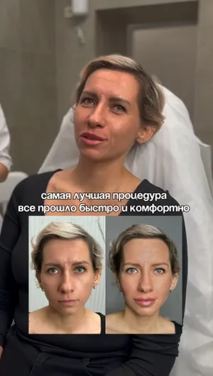 Контурная пластика губ отзывы, результат&nbsp;до&nbsp;и&nbsp;после.