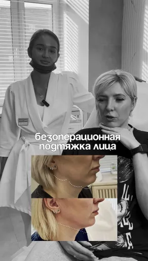 Безоперационная подтяжка лица отзывы, результат&nbsp;до&nbsp;и&nbsp;после.