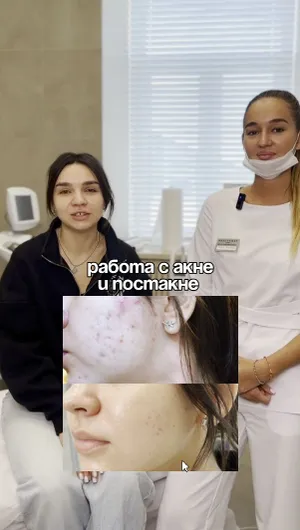 Лечение Акне и Постакне отзывы, результат&nbsp;до&nbsp;и&nbsp;после.