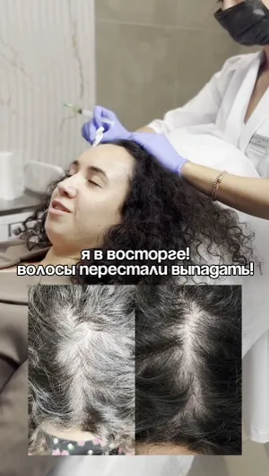 Мезотерапия головы отзывы, результат&nbsp;до&nbsp;и&nbsp;после.