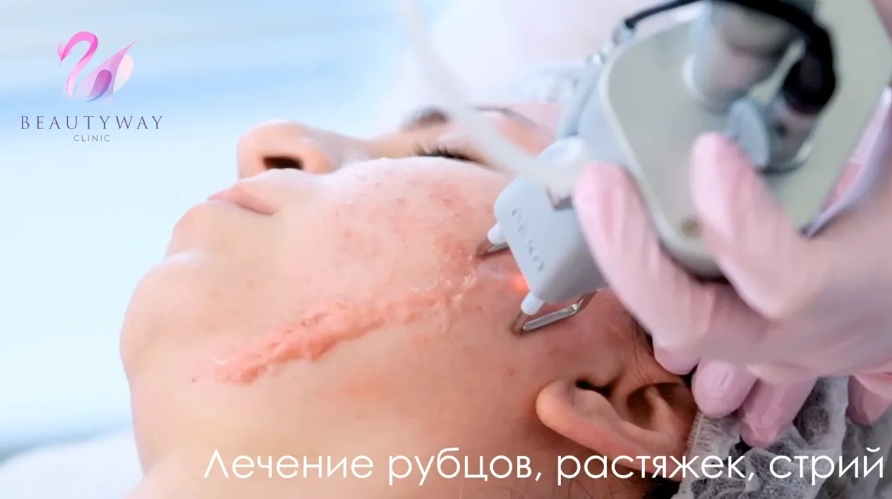 Лазерная шлифовка шрамов и рубцов — видео
